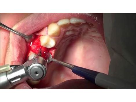 Emergência Dental na Teotônio Vilela